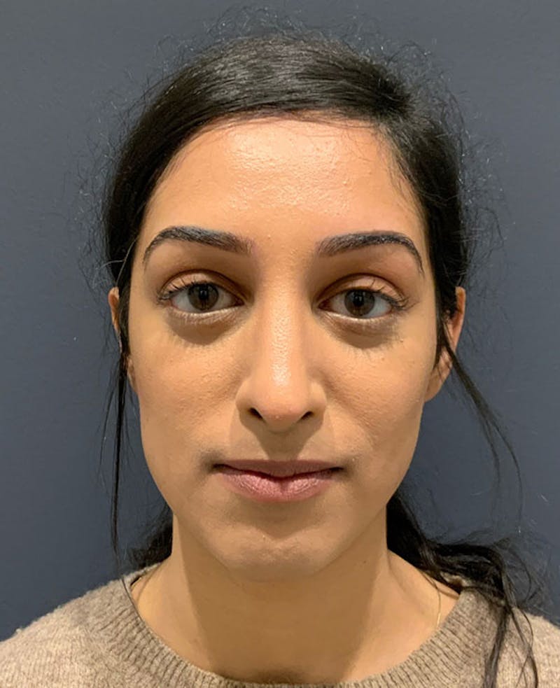 Nose Before & After Gallery - Patient 189960887 - Image 4