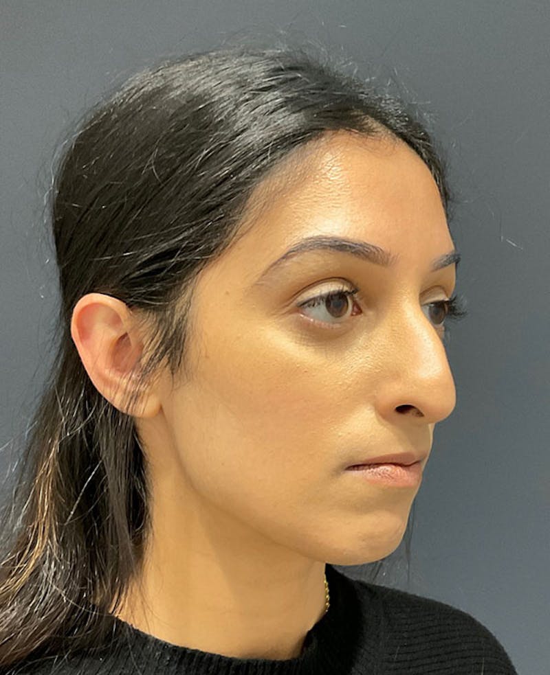 Nose Before & After Gallery - Patient 189960887 - Image 5