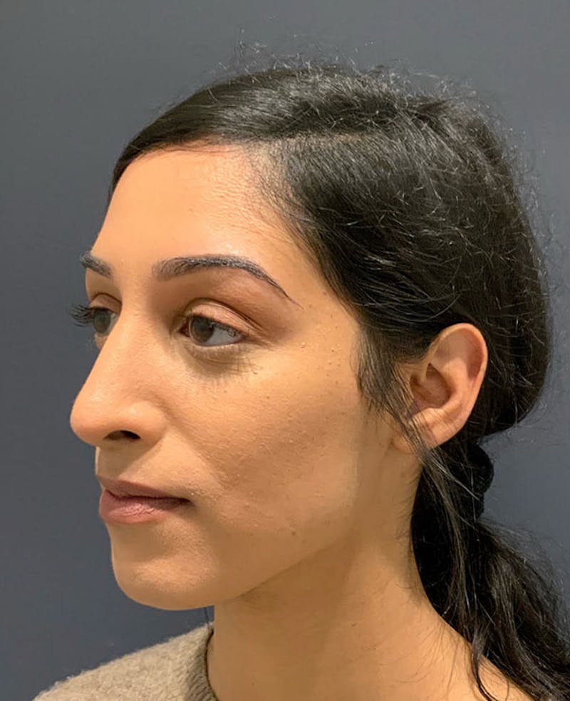 Nose Before & After Gallery - Patient 189960887 - Image 8