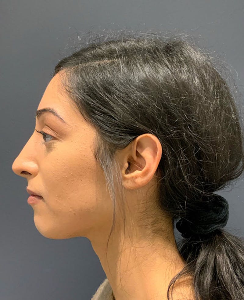Nose Before & After Gallery - Patient 189960887 - Image 2