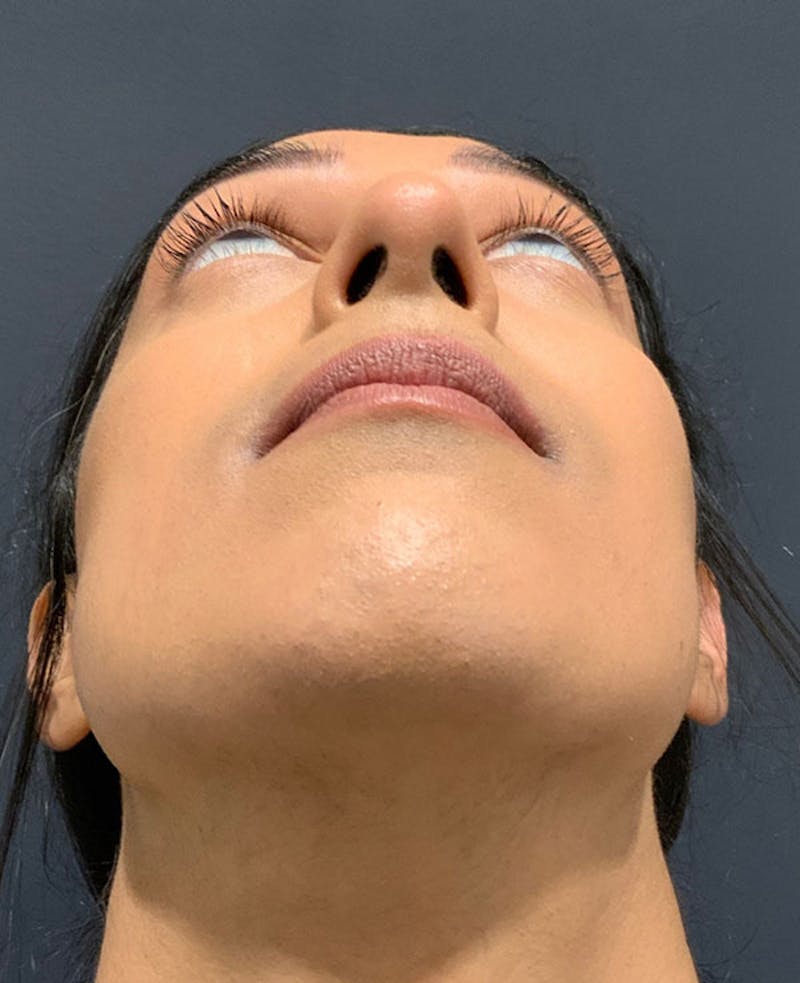 Nose Before & After Gallery - Patient 189960887 - Image 10