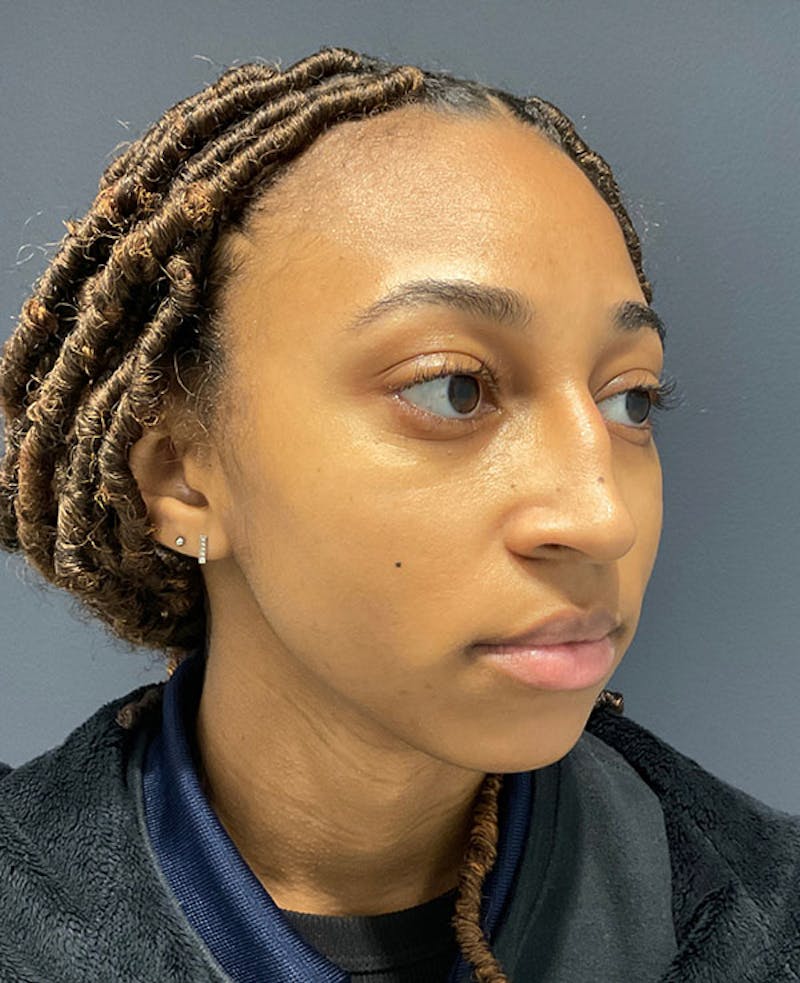 Nose Before & After Gallery - Patient 189960890 - Image 3