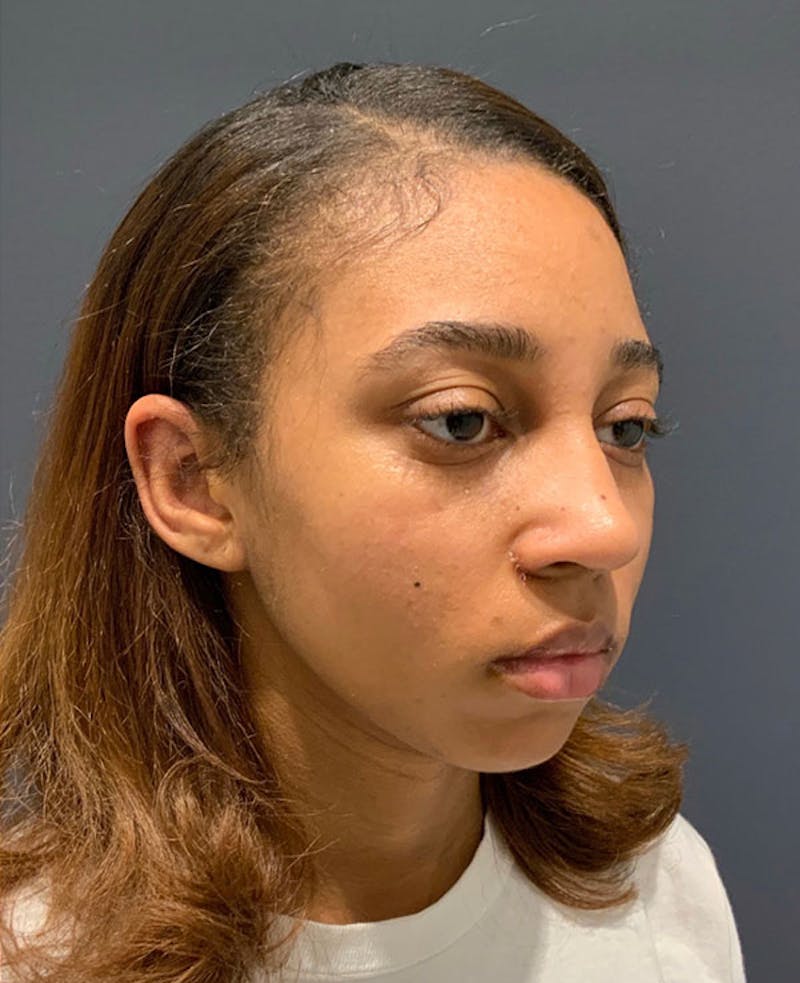 Nose Before & After Gallery - Patient 189960890 - Image 4