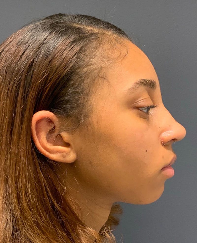 Nose Before & After Gallery - Patient 189960890 - Image 2