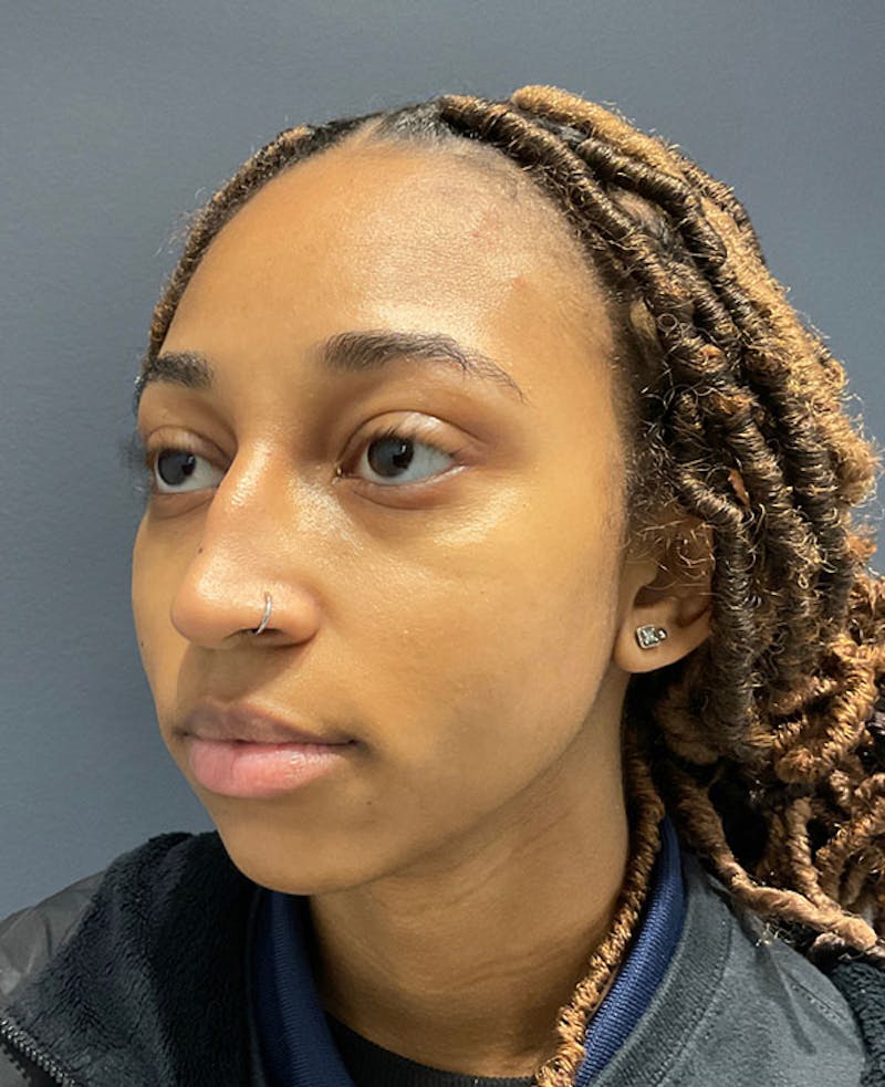 Nose Before & After Gallery - Patient 189960890 - Image 5