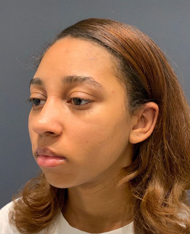 Nose Before & After Gallery - Patient 189960890 - Image 6
