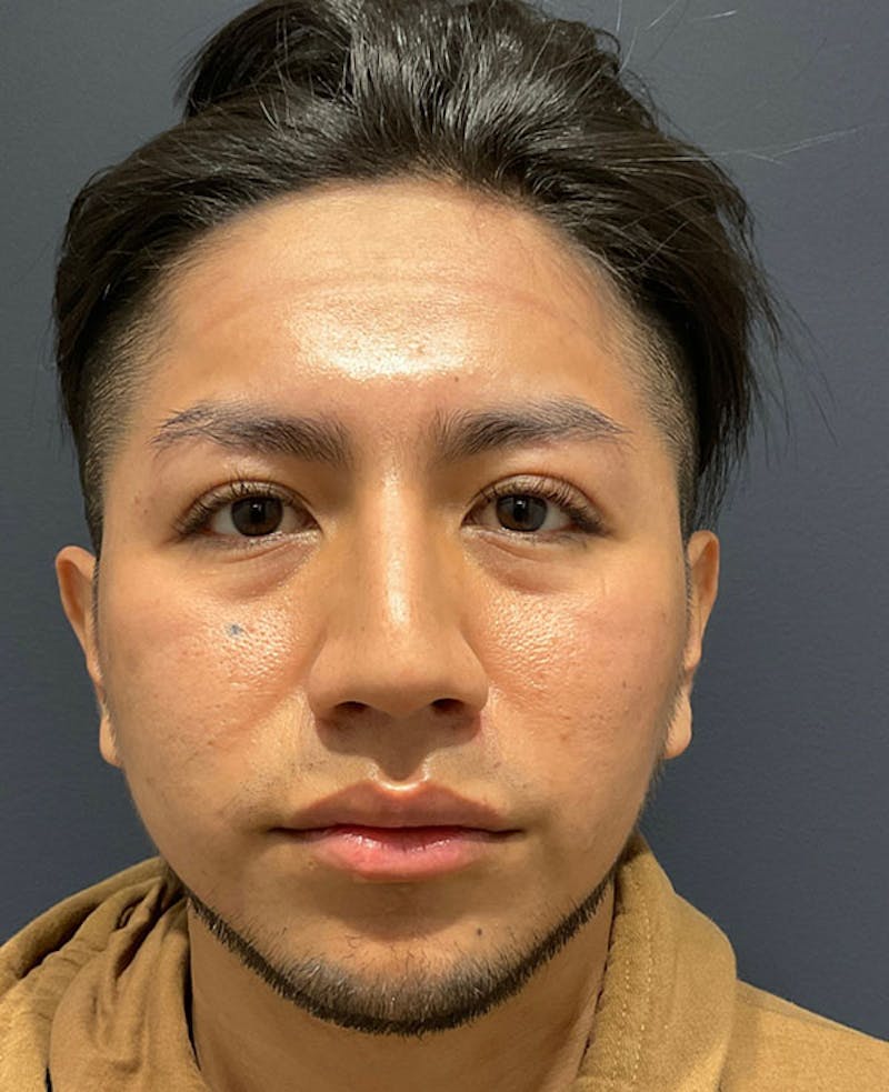 Nose Before & After Gallery - Patient 189960902 - Image 3