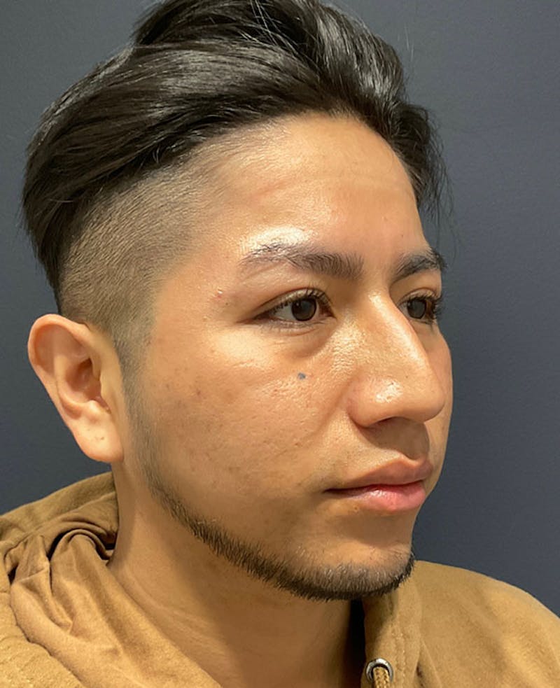 Nose Before & After Gallery - Patient 189960902 - Image 5