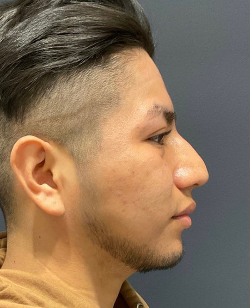 Nose Before & After Gallery - Patient 189960902 - Image 1