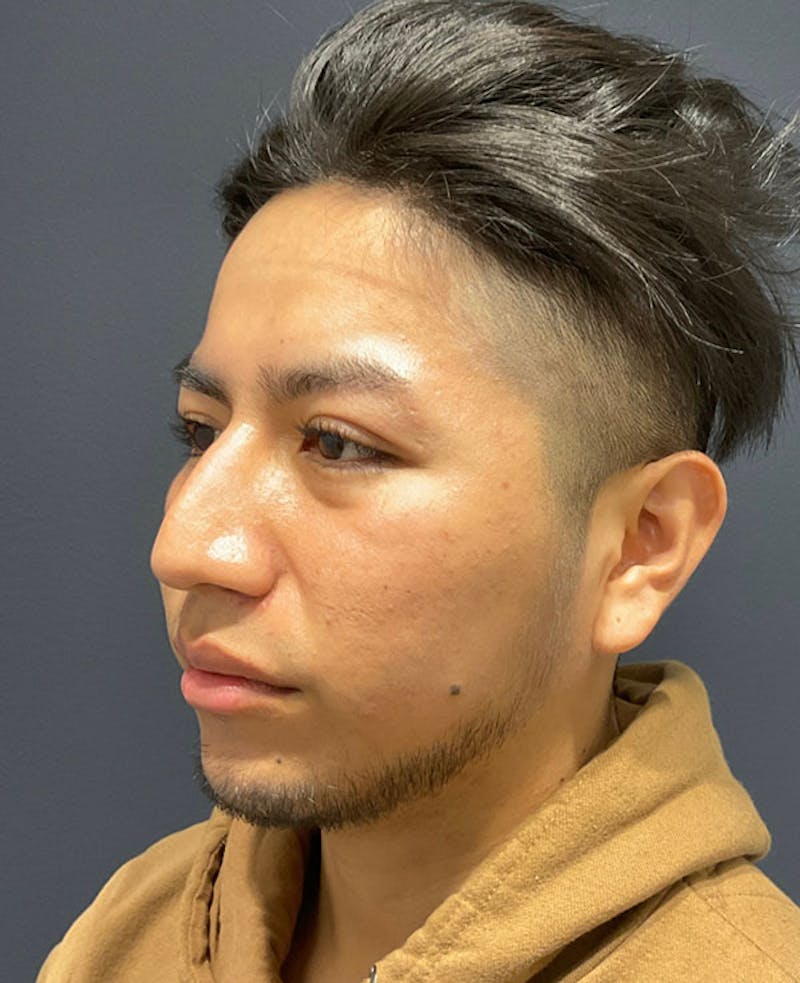 Nose Before & After Gallery - Patient 189960902 - Image 7