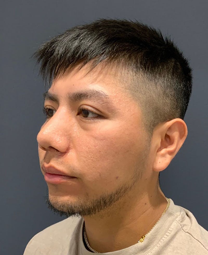 Nose Before & After Gallery - Patient 189960902 - Image 8