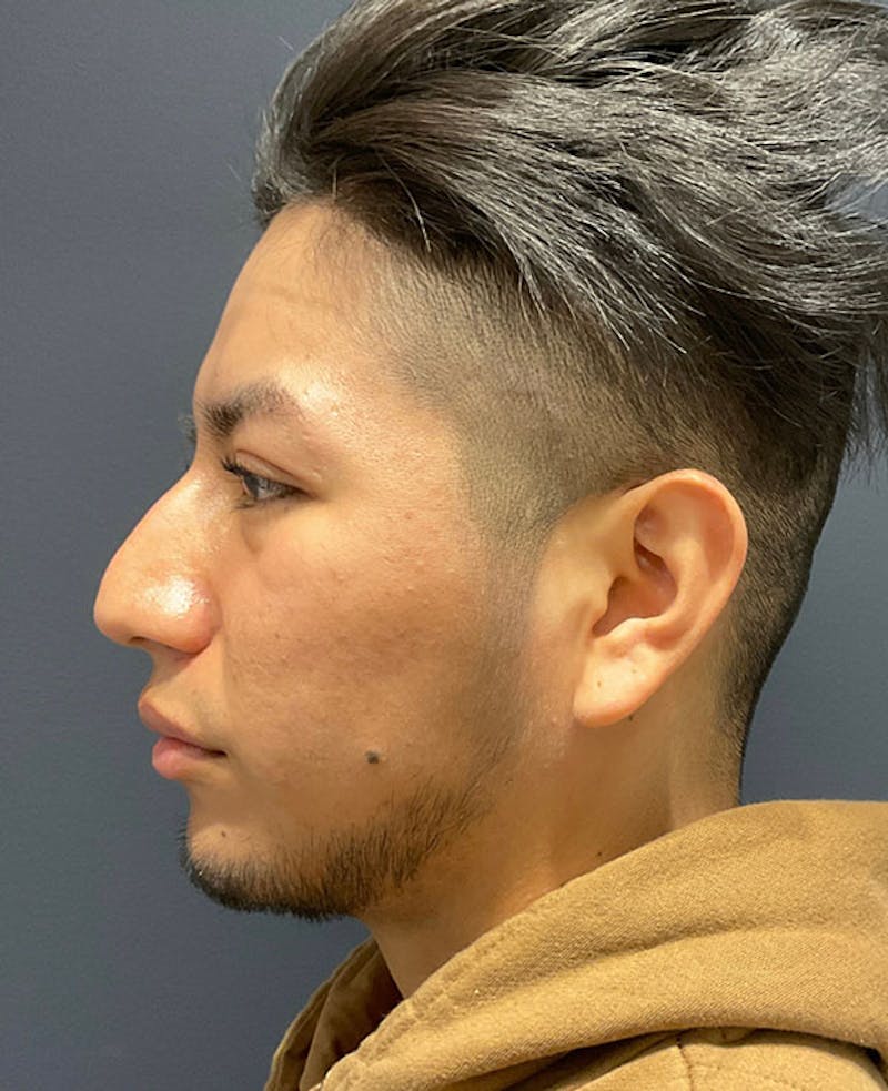 Nose Before & After Gallery - Patient 189960902 - Image 9