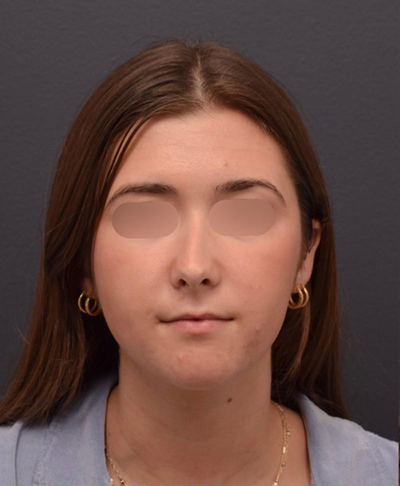 Nose Before & After Gallery - Patient 189960916 - Image 3