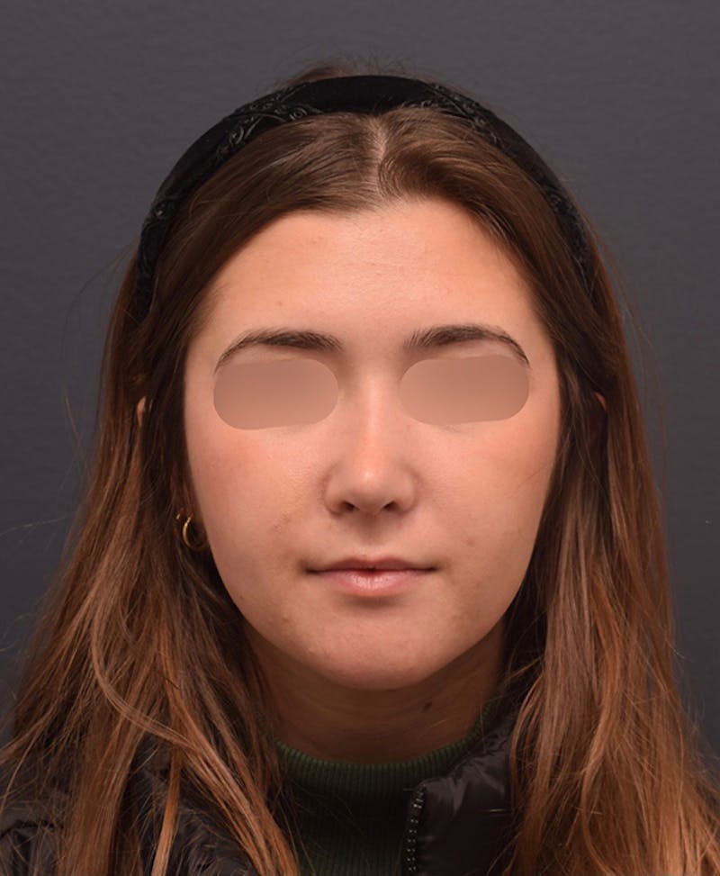 Nose Before & After Gallery - Patient 189960916 - Image 4