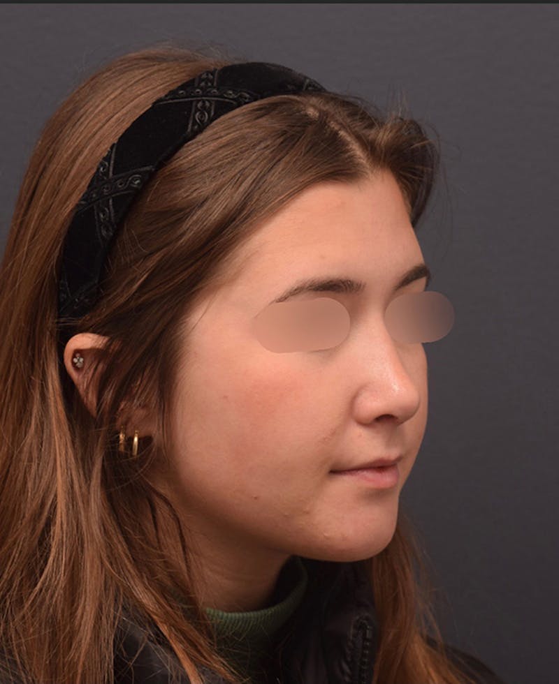 Nose Before & After Gallery - Patient 189960916 - Image 6