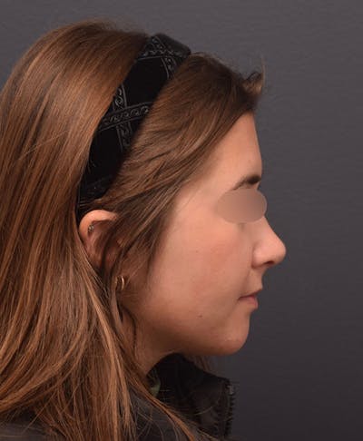 Nose Before & After Gallery - Patient 189960916 - Image 2
