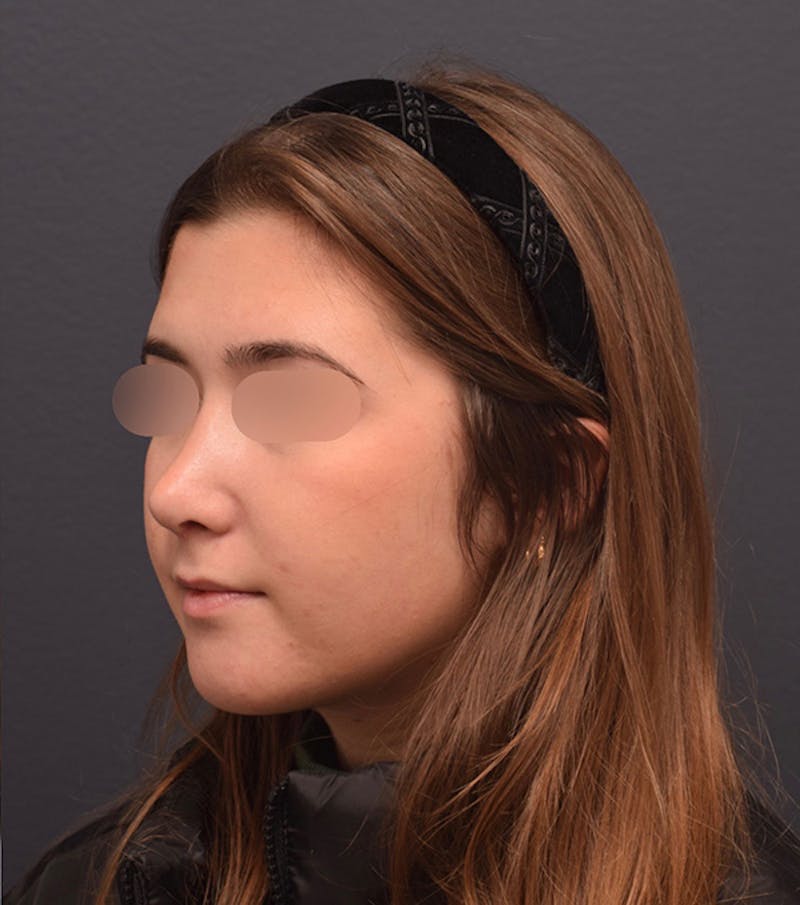 Nose Before & After Gallery - Patient 189960916 - Image 8