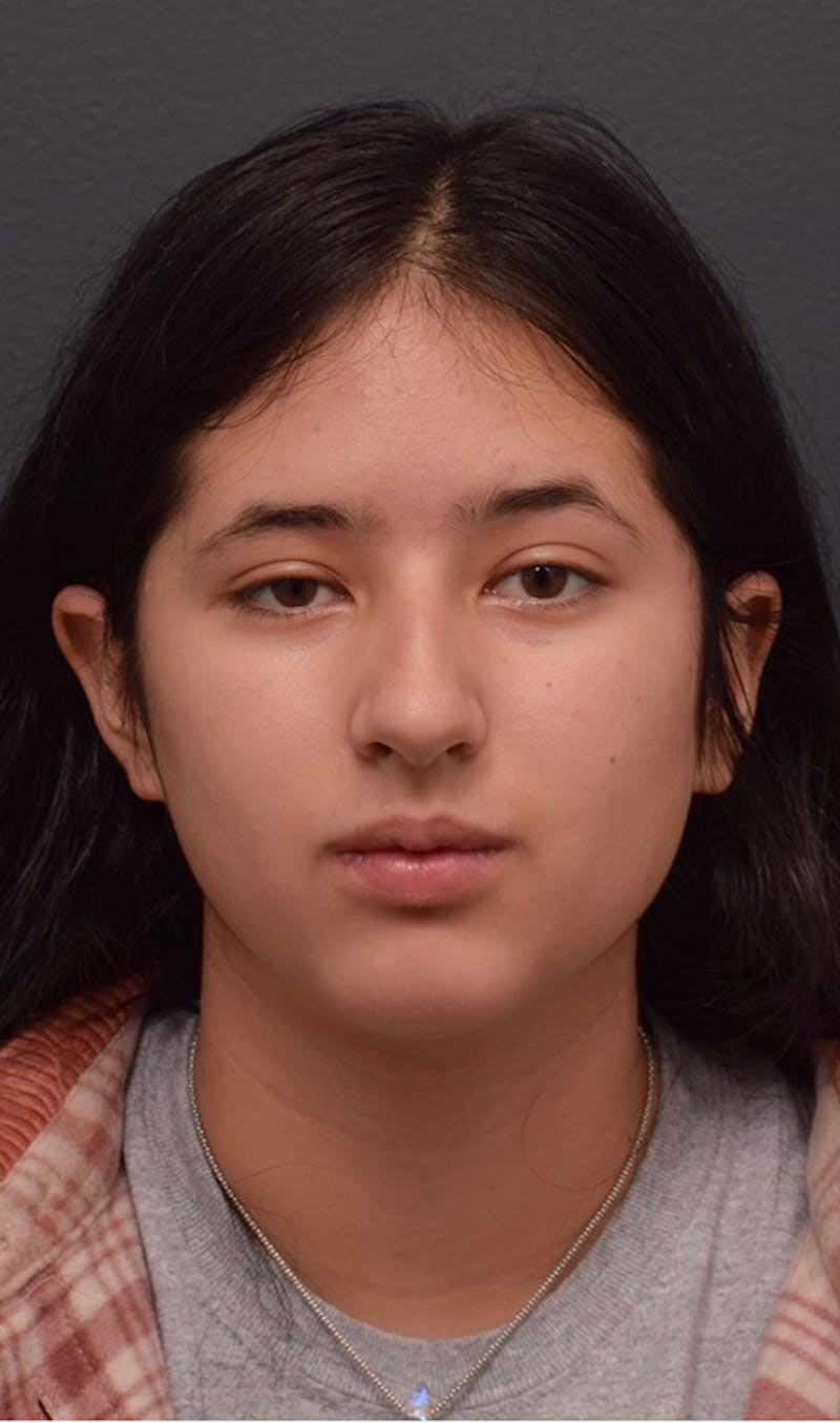 Nose Before & After Gallery - Patient 189961601 - Image 3