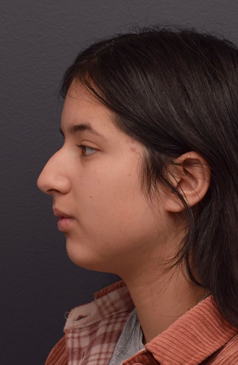 Nose Before & After Gallery - Patient 189961601 - Image 9