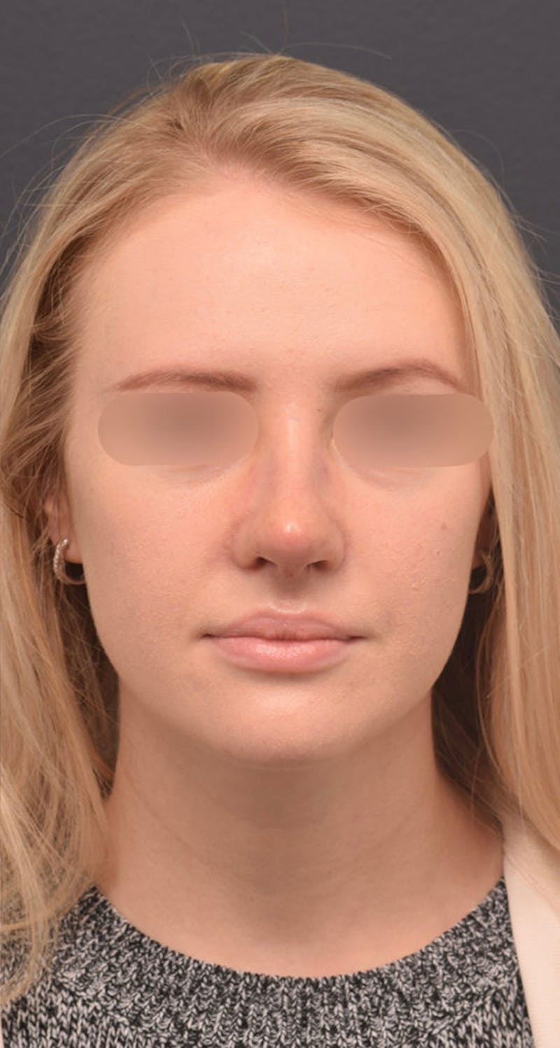 Nose Before & After Gallery - Patient 189961611 - Image 4