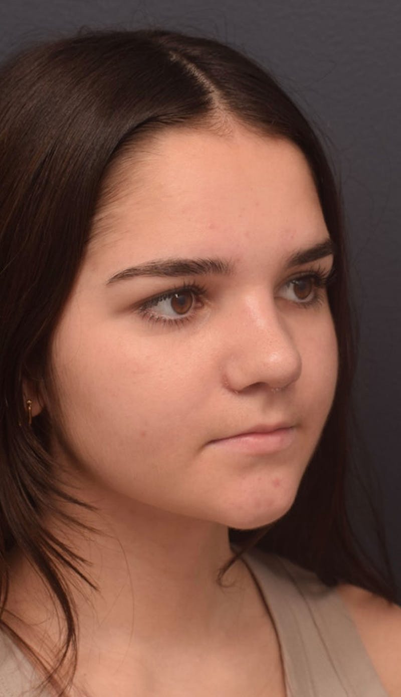 Nose Before & After Gallery - Patient 189961613 - Image 6