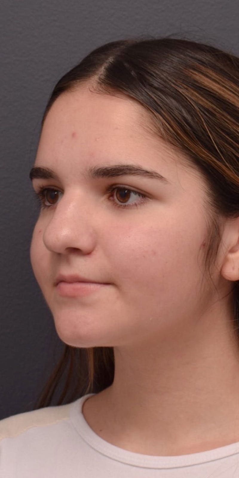 Nose Before & After Gallery - Patient 189961613 - Image 7