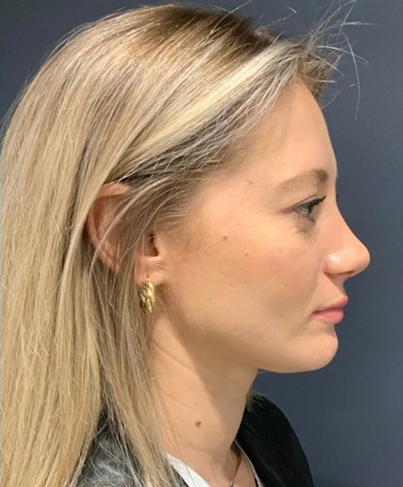 Nose Before & After Gallery - Patient 189961614 - Image 2