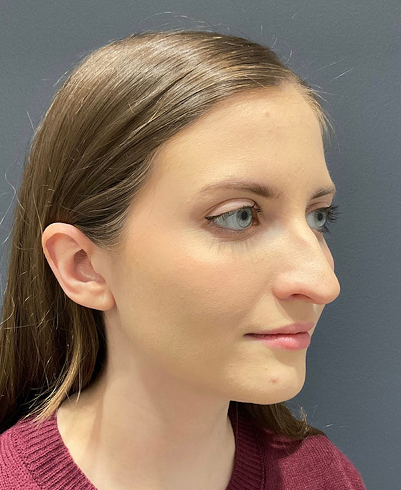 Nose Before & After Gallery - Patient 189961616 - Image 3