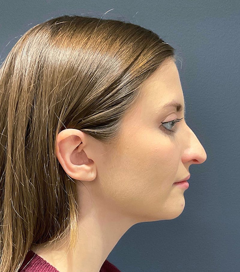 Nose Before & After Gallery - Patient 189961616 - Image 1