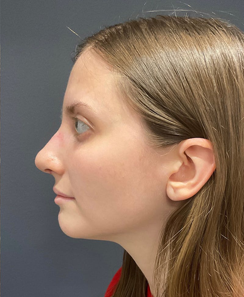 Nose Before & After Gallery - Patient 189961616 - Image 6