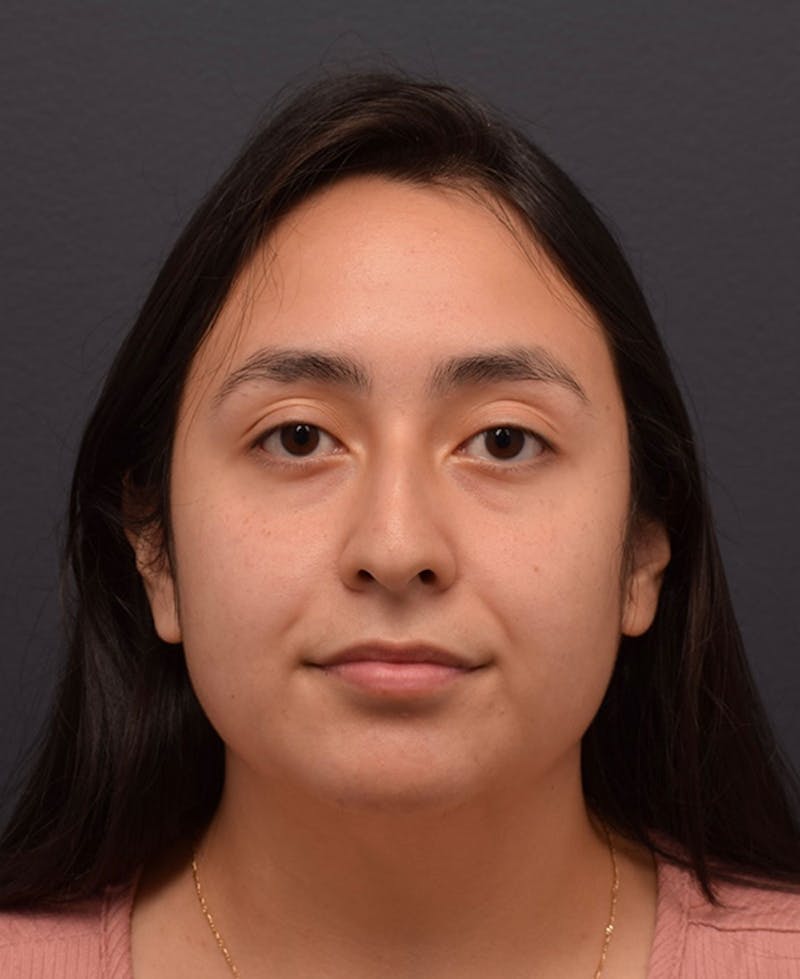 Nose Before & After Gallery - Patient 189961641 - Image 3