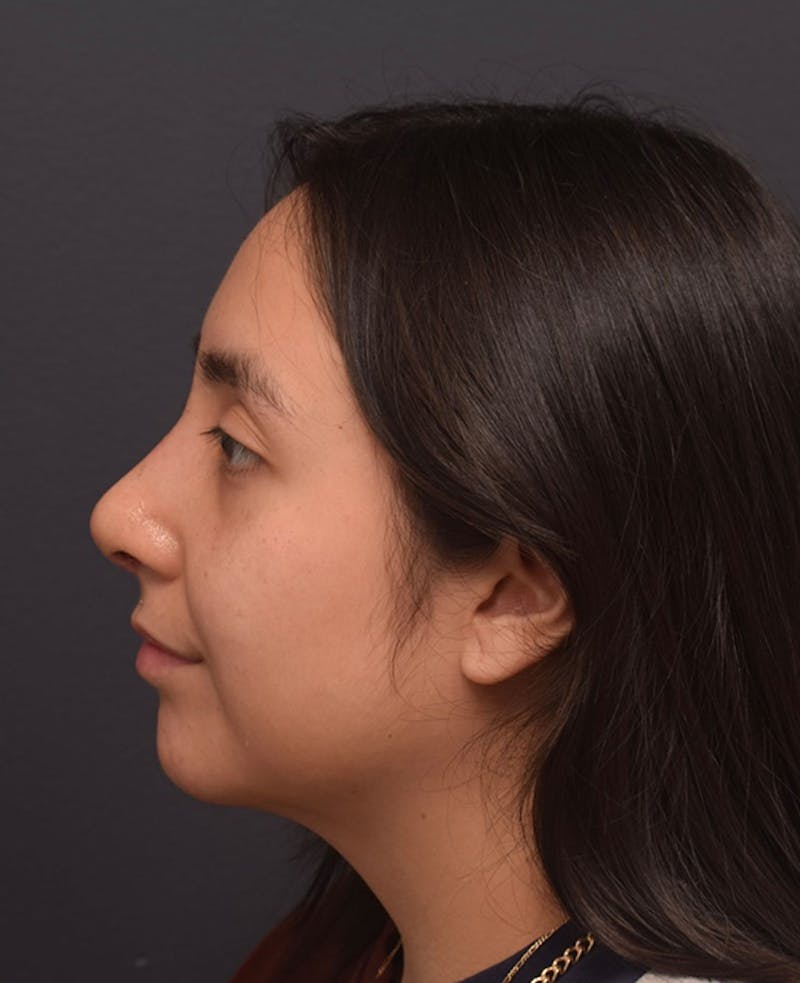 Nose Before & After Gallery - Patient 189961641 - Image 2