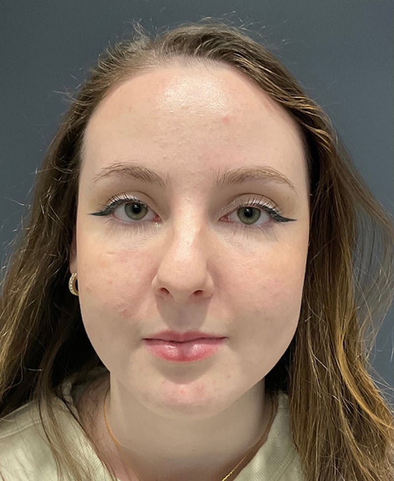 Nose Before & After Gallery - Patient 189961643 - Image 3
