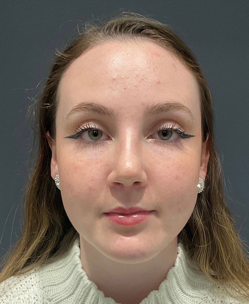 Nose Before & After Gallery - Patient 189961643 - Image 4
