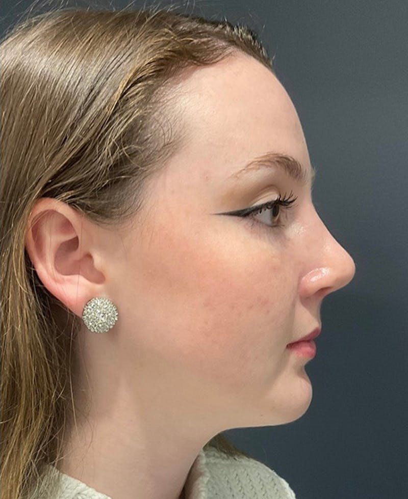 Nose Before & After Gallery - Patient 189961643 - Image 2