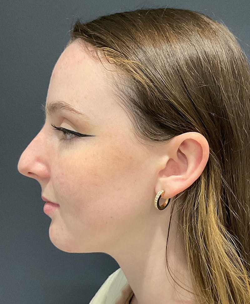 Nose Before & After Gallery - Patient 189961643 - Image 5