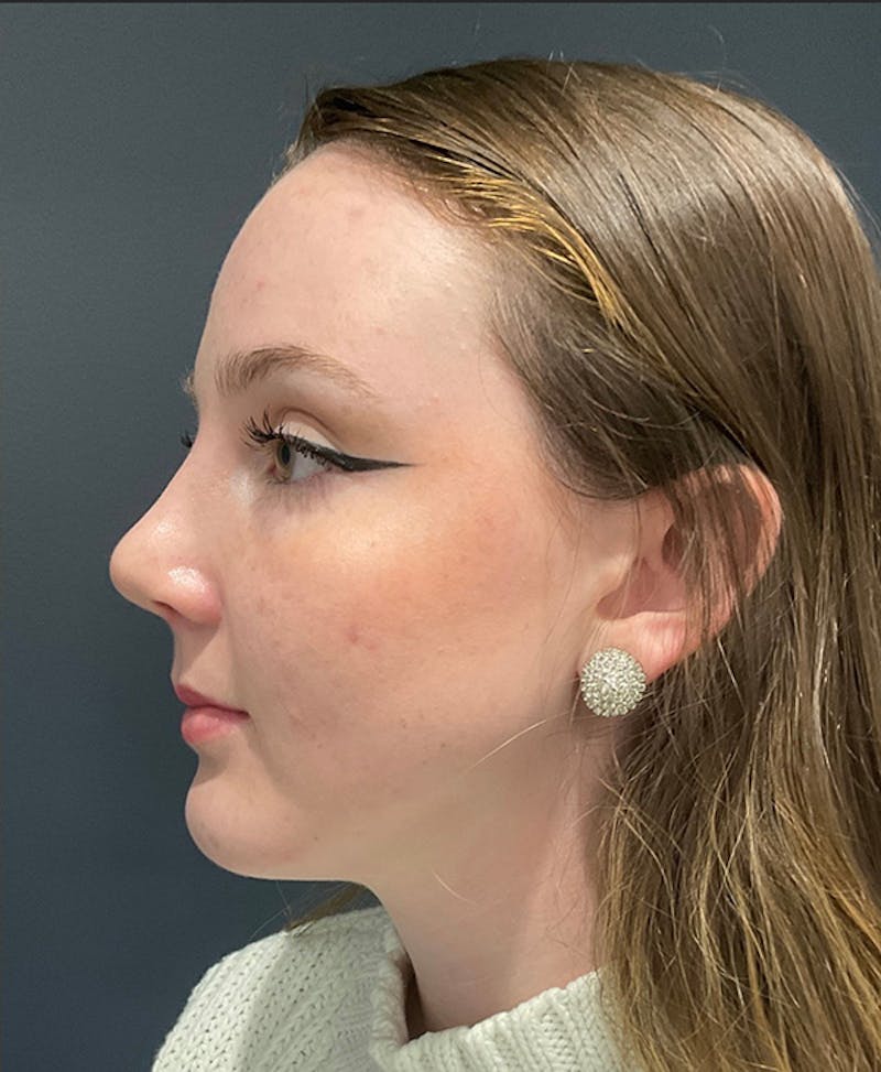 Nose Before & After Gallery - Patient 189961643 - Image 6