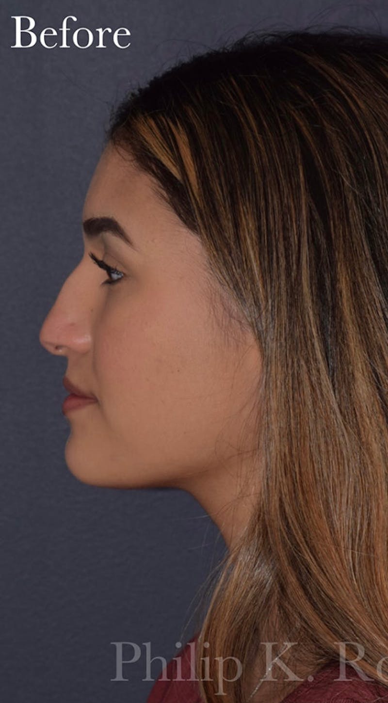 Nose Before & After Gallery - Patient 189961646 - Image 7