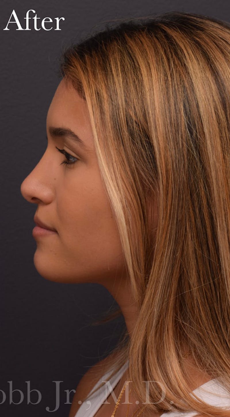Nose Before & After Gallery - Patient 189961646 - Image 8