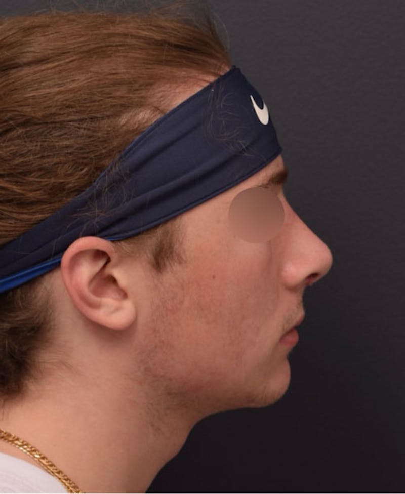 Nose Before & After Gallery - Patient 189961648 - Image 2