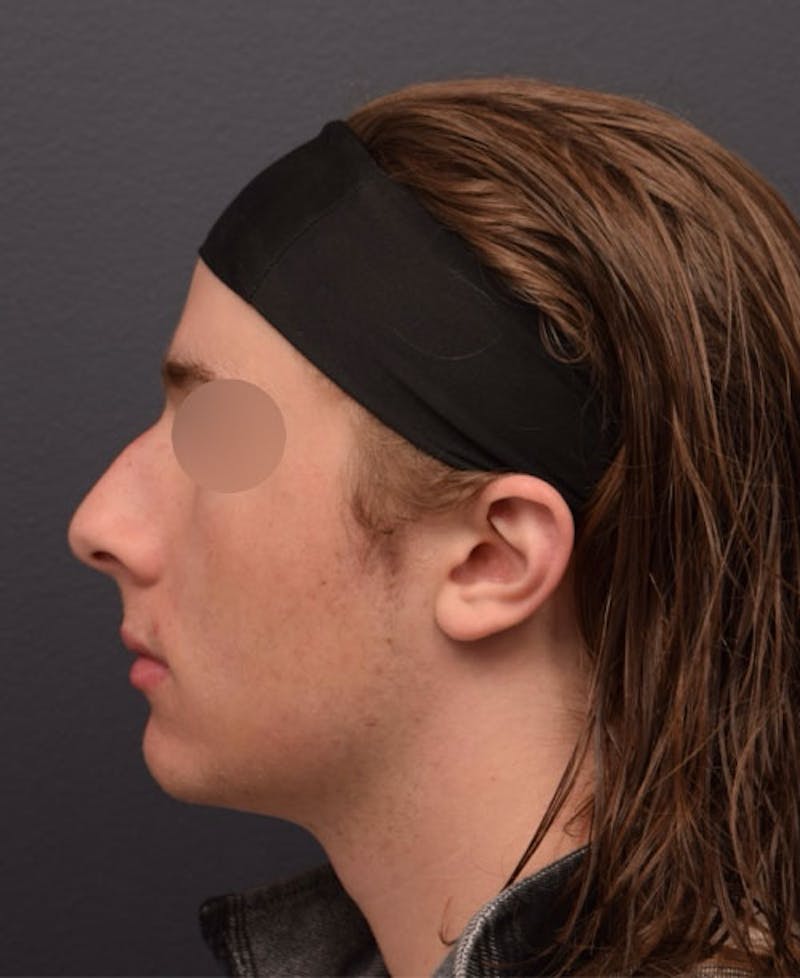 Nose Before & After Gallery - Patient 189961648 - Image 3