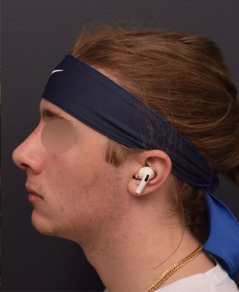 Nose Before & After Gallery - Patient 189961648 - Image 4