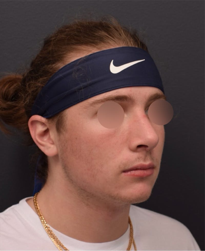 Nose Before & After Gallery - Patient 189961648 - Image 6