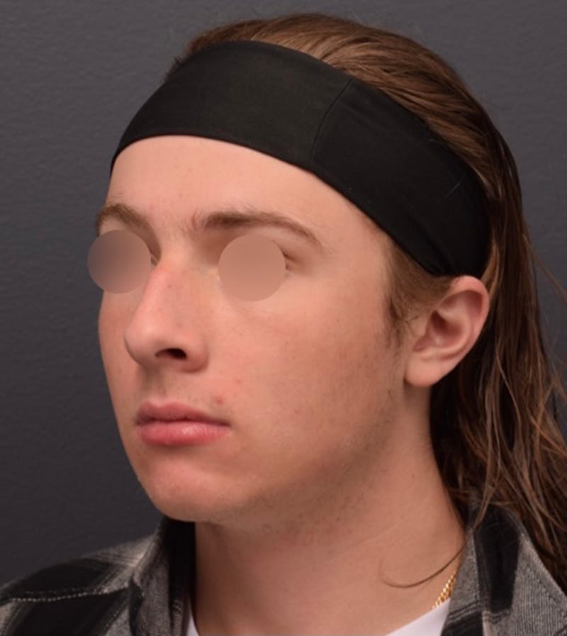 Nose Before & After Gallery - Patient 189961648 - Image 7