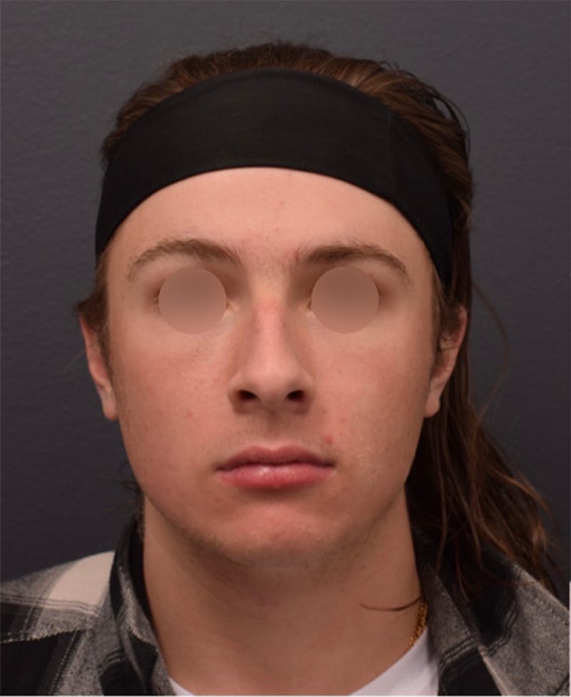 Nose Before & After Gallery - Patient 189961648 - Image 9