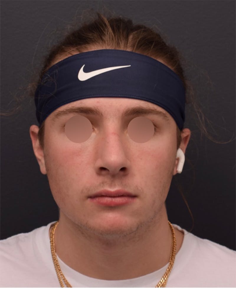 Nose Before & After Gallery - Patient 189961648 - Image 10