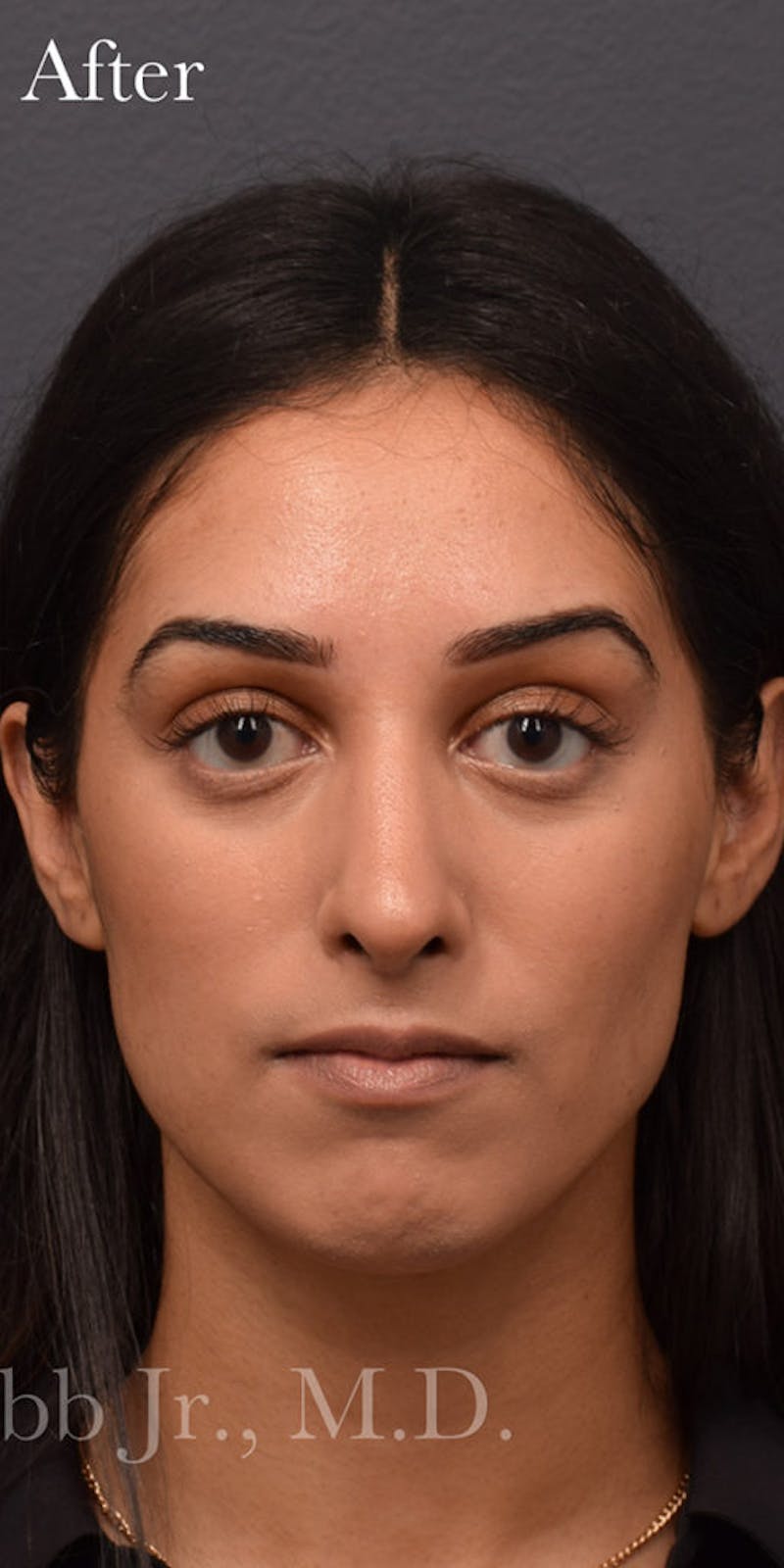 Nose Before & After Gallery - Patient 189961649 - Image 4