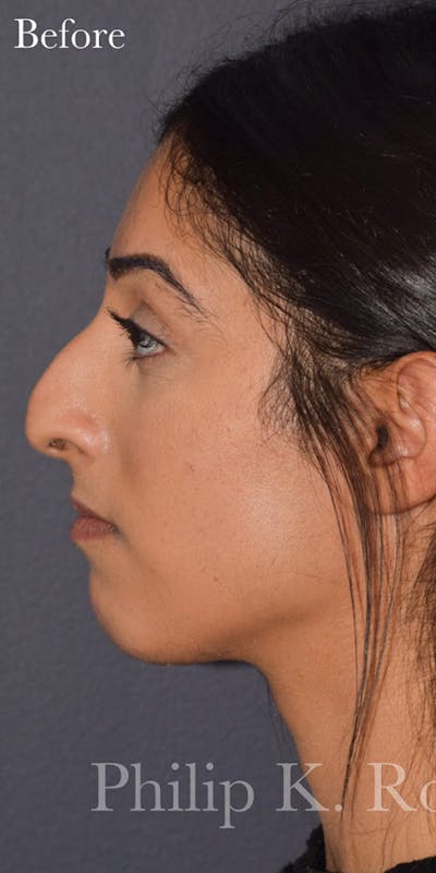 Nose Before & After Gallery - Patient 189961649 - Image 1