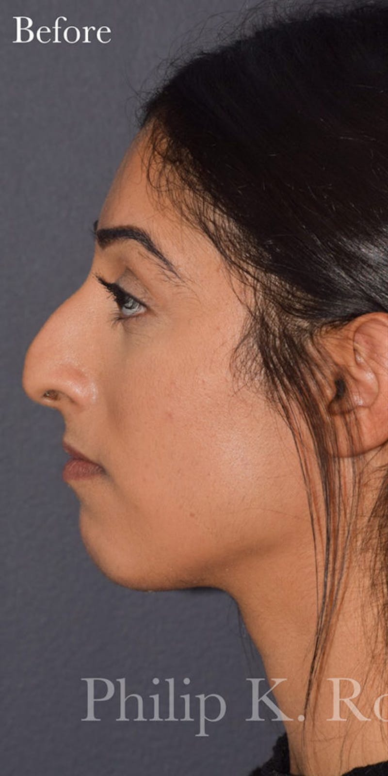 Nose Before & After Gallery - Patient 189961649 - Image 1
