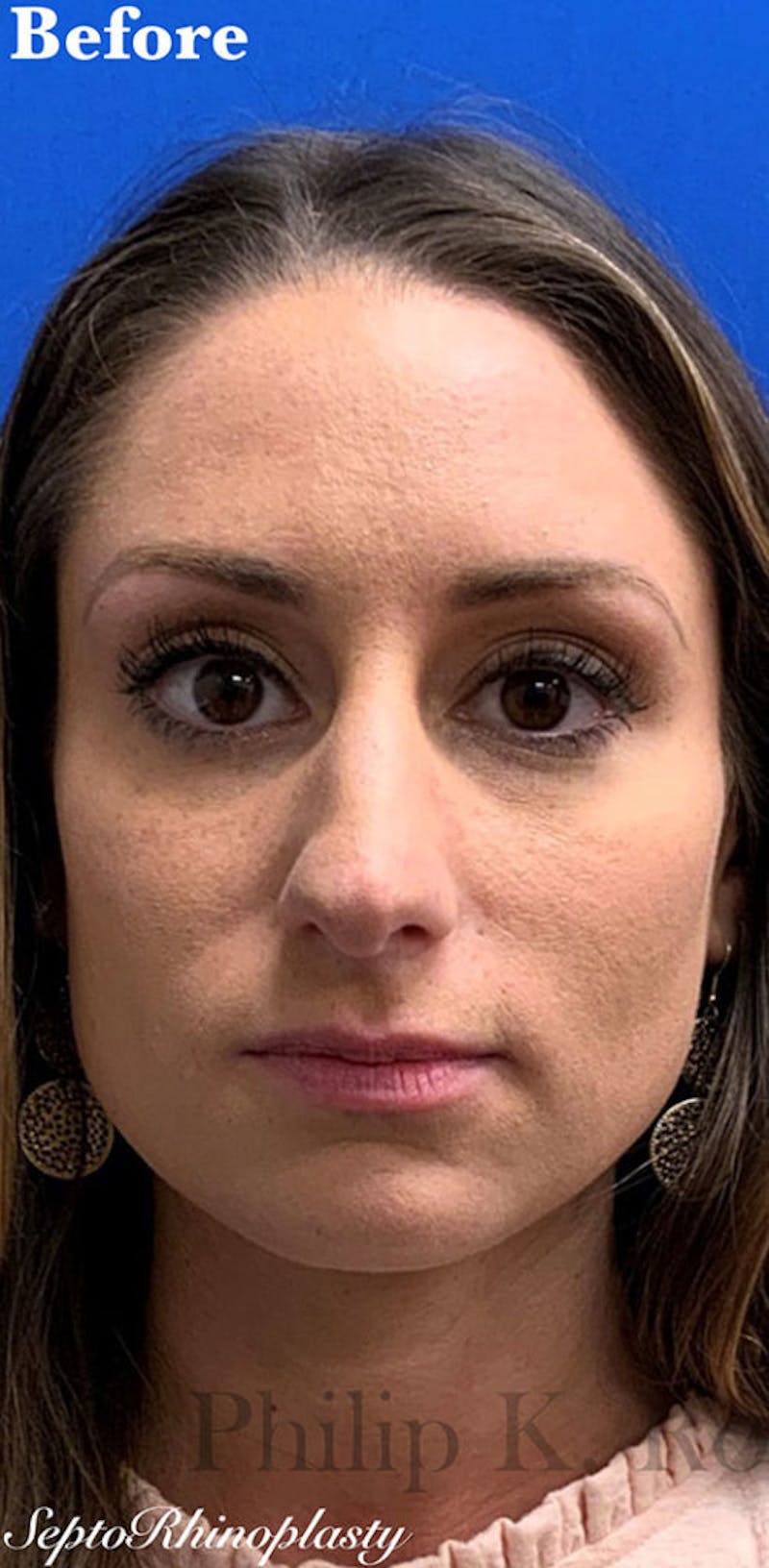 Nose Before & After Gallery - Patient 189961658 - Image 3